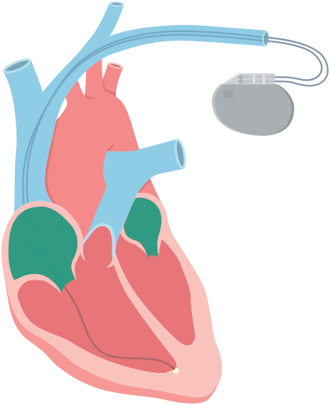 The Ventricles Beat Very Quickly And Can Lead To Ventricular - Illustration (464x569)