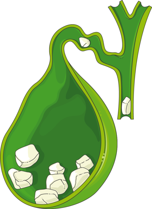 Biliary Lithiasis - Biliary Lithiasis (493x680)