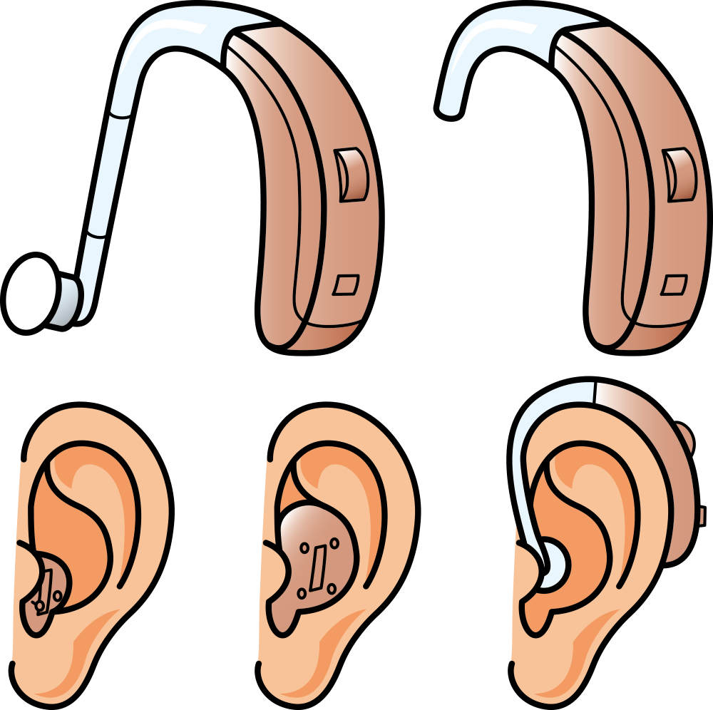 Hearing Aid Hearing Loss - Hearing Aid Hearing Loss (1000x996)