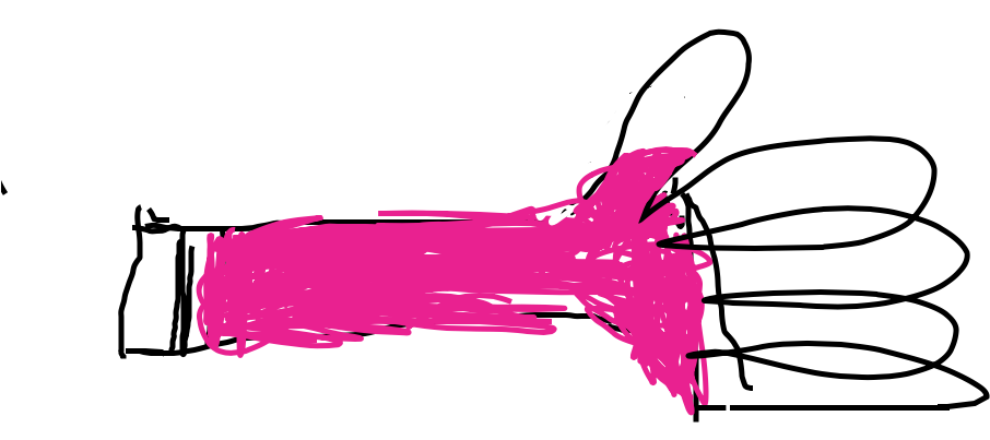 She Got A Cast In Pink After 6 Weeks, She Got It Off - Illustration (910x470)