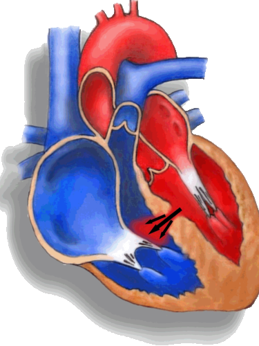 Click Link To Watch Animation Interventional Cardiology - Vsd (375x500)