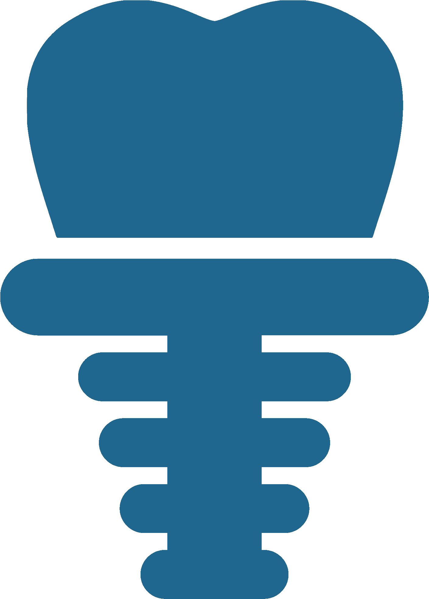 Dental Implants - Dental Implant (1416x1973)