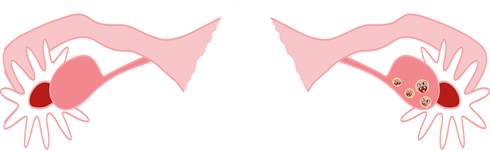 Medical Treatment Pcos - Polycystic Ovary Syndrome (700x215)