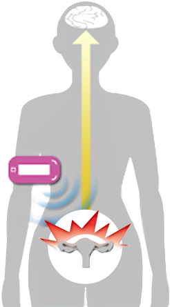 탠스 의 원리 - Transcutaneous Electrical Nerve Stimulation (414x512)
