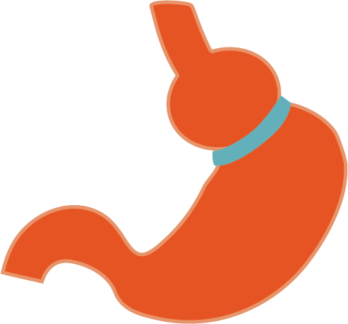 Laparoscopic Adjustable Gastric Band Is A Type Of Weight - Adjustable Gastric Band (493x458)