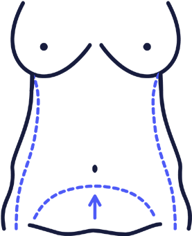Abdominoplasty - Abdominoplasty (400x400)