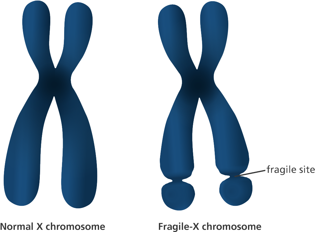 The Center For Disease Control Describe Autism Spectrum - Fragile X Mental Retardation 1 (1200x832)