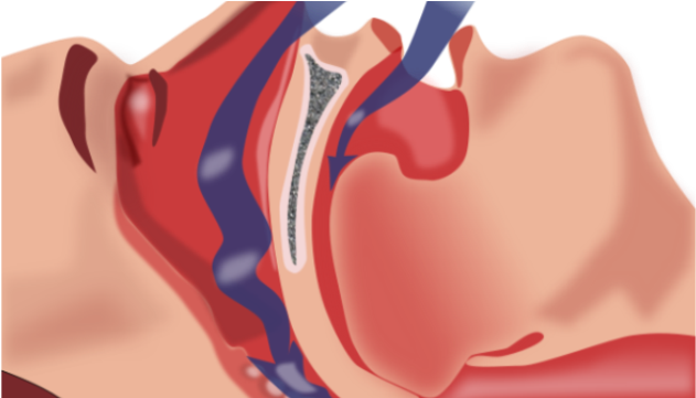 Brain Damage Caused By Severe Sleep Apnea Is Reversible - Sleep Hacks: Tips For Apnea Cure Today! (640x360)