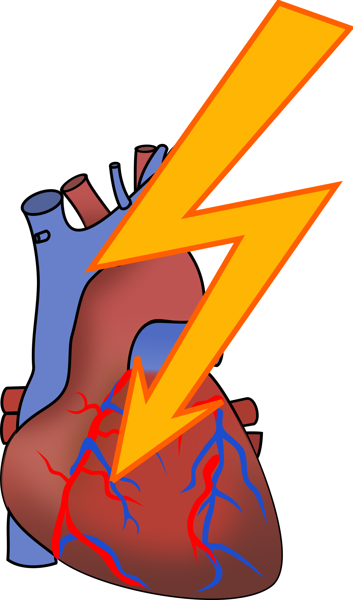 Big Image - Clip Art Heart Attack (1414x2400)