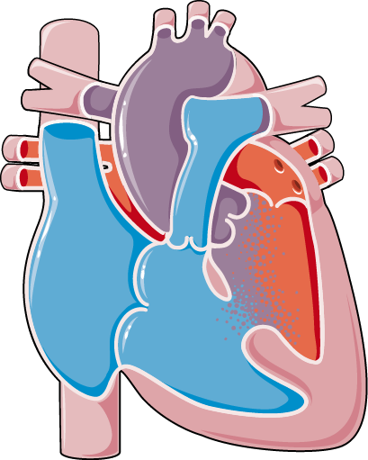 Congenital Heart Disease - Ventricular Septal Defect (409x511)