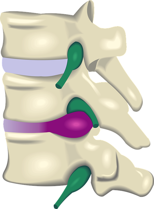 Disc Injury Herniation, Bulge, Protrusion Understanding - Spinal Disc Herniation (531x720)