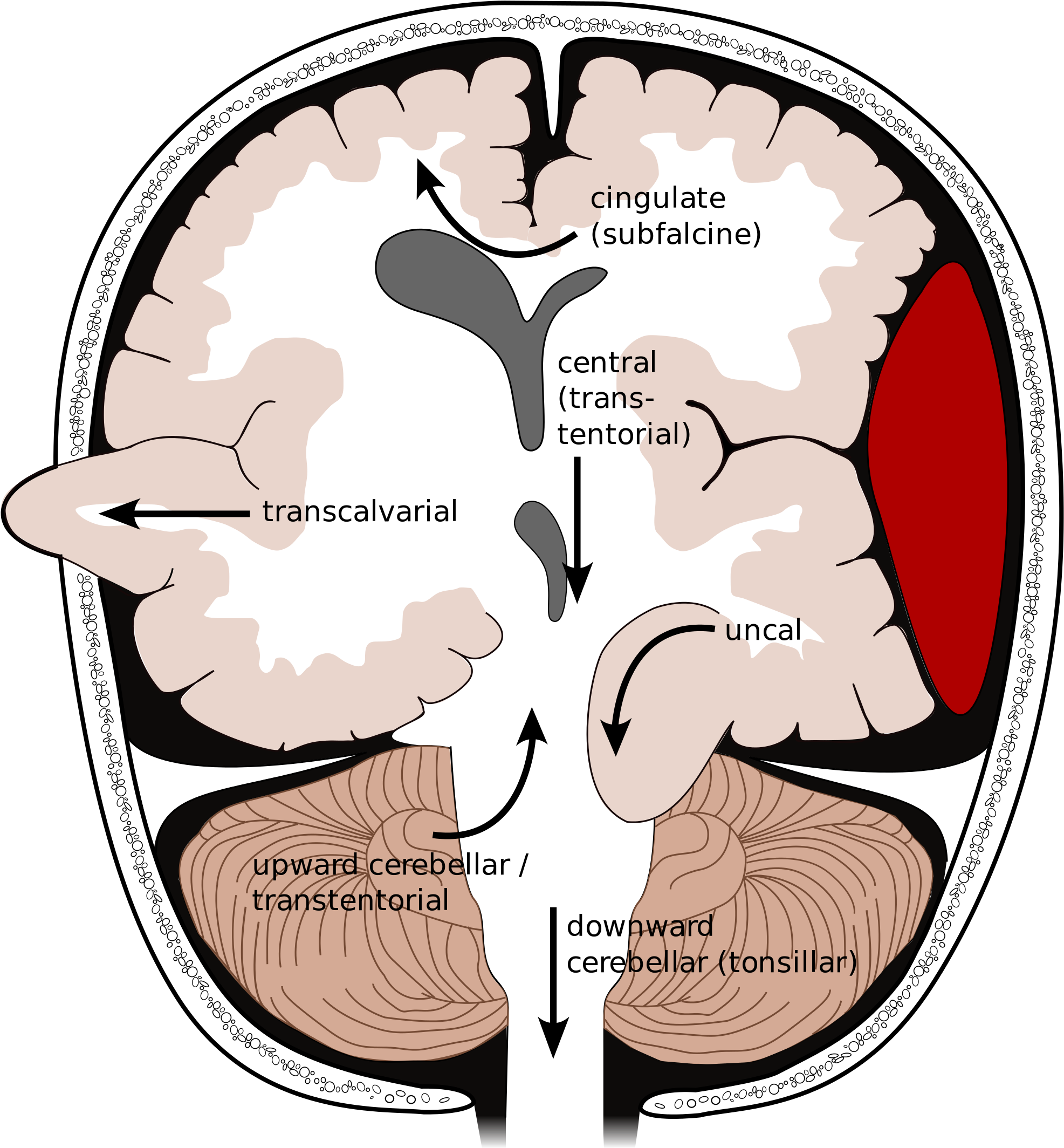 Types Of Brain Herniation[3] 1) Uncal 2) Central 3) - Brain Herniation (2000x2171)