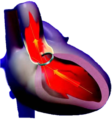 Correct Orientation Of Mechanical Disc And Bileaflet - Correct Orientation Of Mechanical Disc And Bileaflet (393x420)