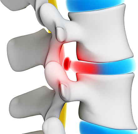 Patients May Come To Austin Surgical Institute For - Bel Fıtığı (441x428)