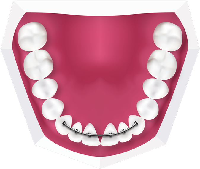 Fixed Braces At Toothbeary Fixed Retainers At Toothbeary - Human Teeth Model (700x586)