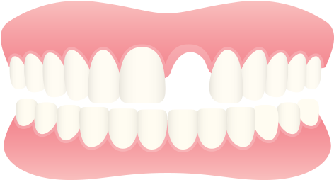 Replacement Of Missing Teeth - Teeth In Row Vector (500x300)