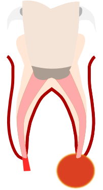 Preparation Of The Root Canals - Preparation Of The Root Canals (500x626)