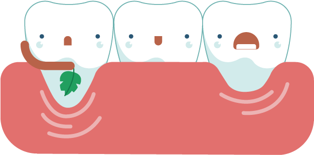 Receding Gum Solutions Pinhole Surgical Technique - Gums (822x595)