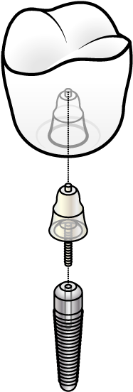 If Missing Teeth Are Leaving You Feeling Self-concious - Dental Implant (229x602)