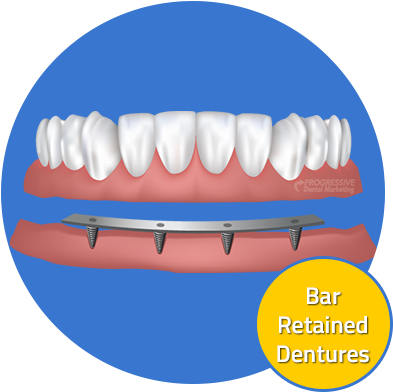 Custom Dental Offers A Variety Of Dental Implant Options - Dentures (400x400)
