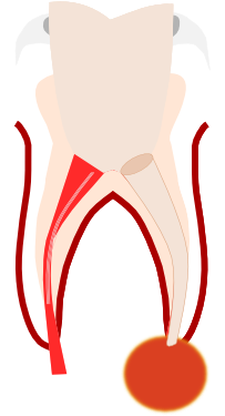Preparation Of The Root Canals - Preparation Of The Root Canals (500x626)