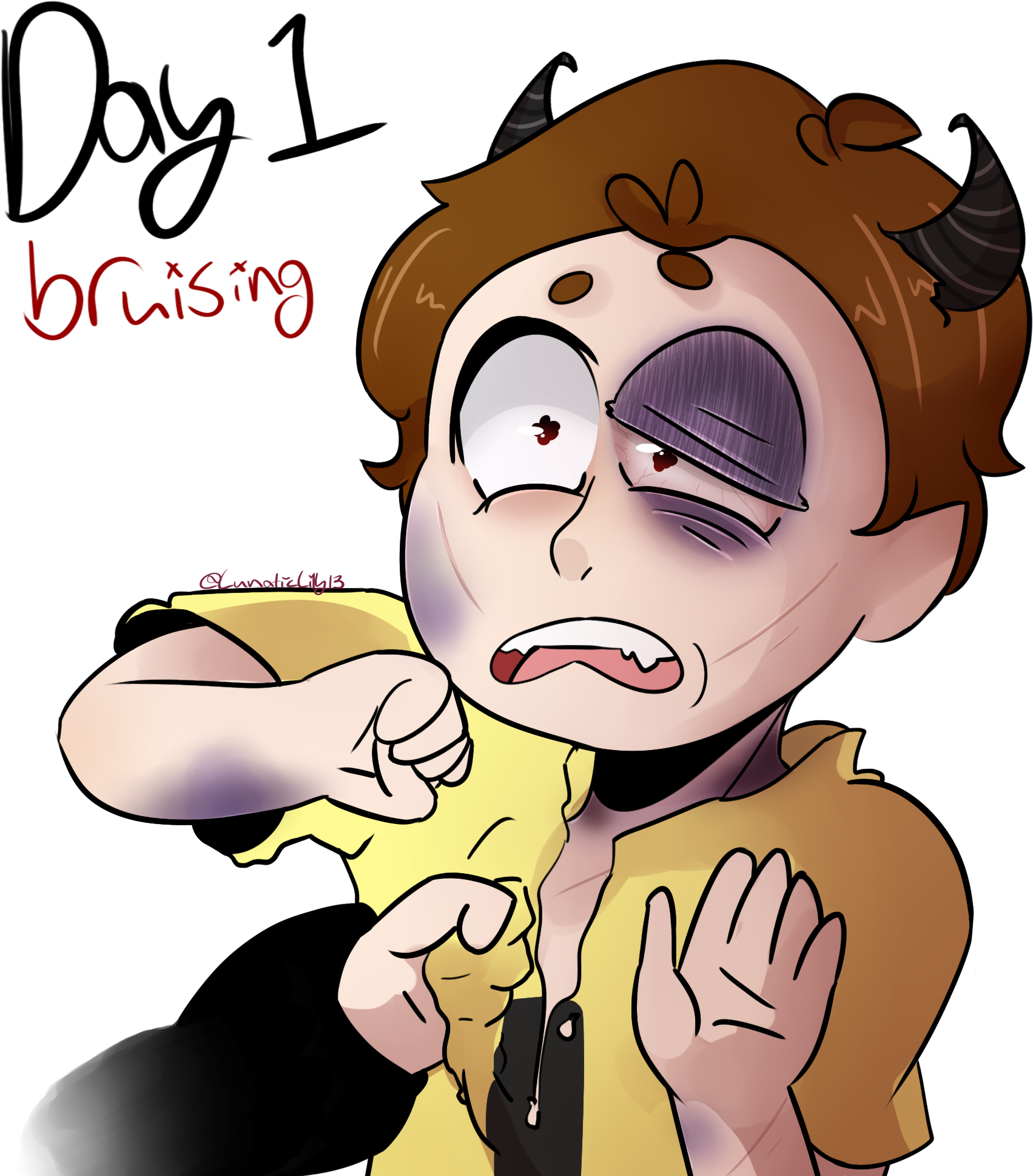 {day 1} Bruising By Lunaticlily13 - Drawing (2000x2000)