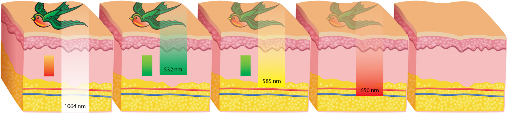 Unwanted Dark And Multi-colored Tattoos Can Be Safely - Illustration (1920x598)