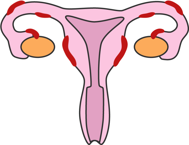 Endometriosis V2 - Health (800x800)