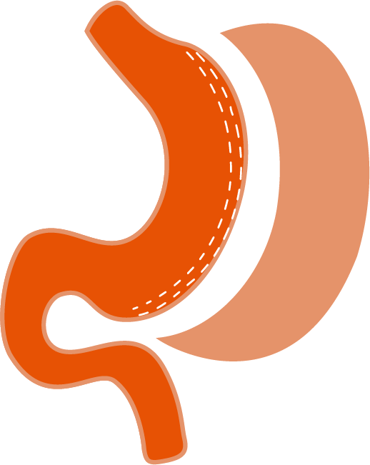 Laparoscopic Sleeve Gastrectomy - Graphic Design (518x651)