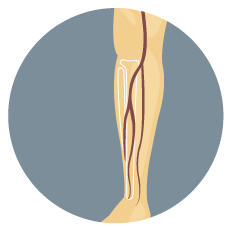 Peripheral Arterial Disease Illustration - Illustration (356x357)