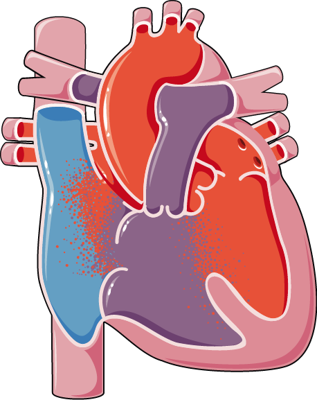 Congenital Heart Disease Atrioventricular Canal Defect - Ventricular Septal Defect (458x577)