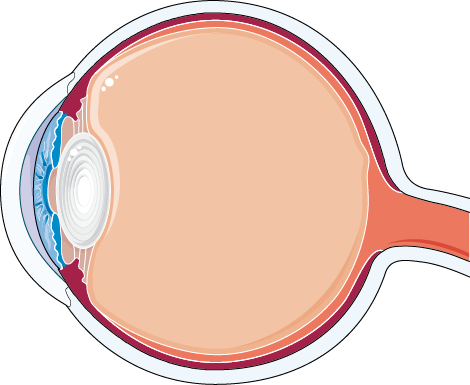 Cataract - Cataract Surgery (470x385)