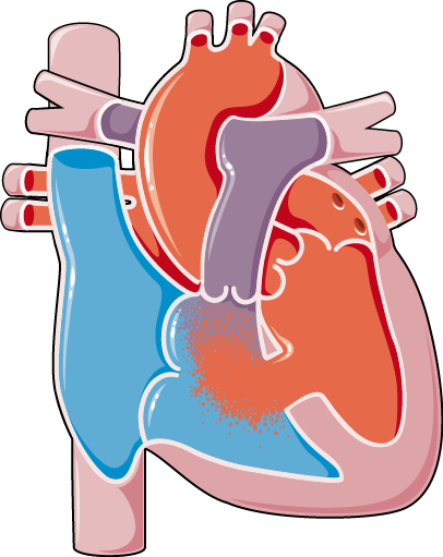 Congenital Heart Disease Ventricular Septal Defect - Heart Septal Defect (406x511)