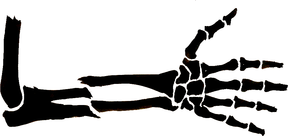 Bone Fracture Arm Drawing Clavicle Clip Art - Broken Arm Clip Art (1100x527)