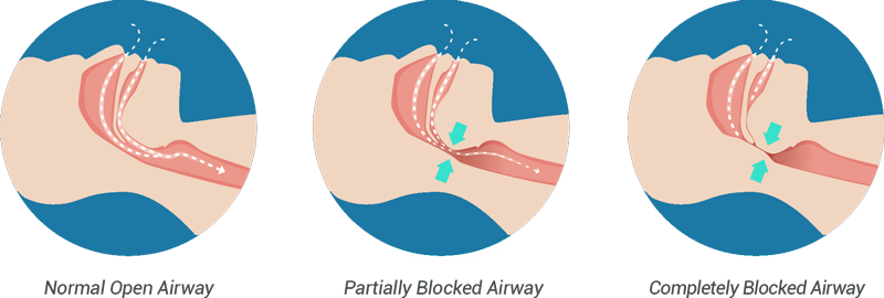 Hydrated Reduces Snoring - Causes People To Snore (800x270)