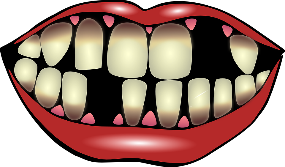 Various Types Of Dental Services - Wisdom Tooth (960x562)