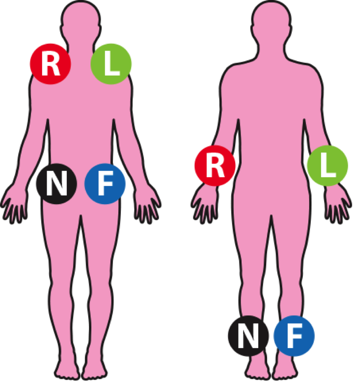 Augmented Leads Placement Chart - Ecg Limb Lead Placement (719x776)