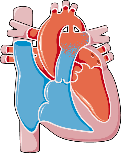 Download The Image - Ventricular Septal Defect (406x511)