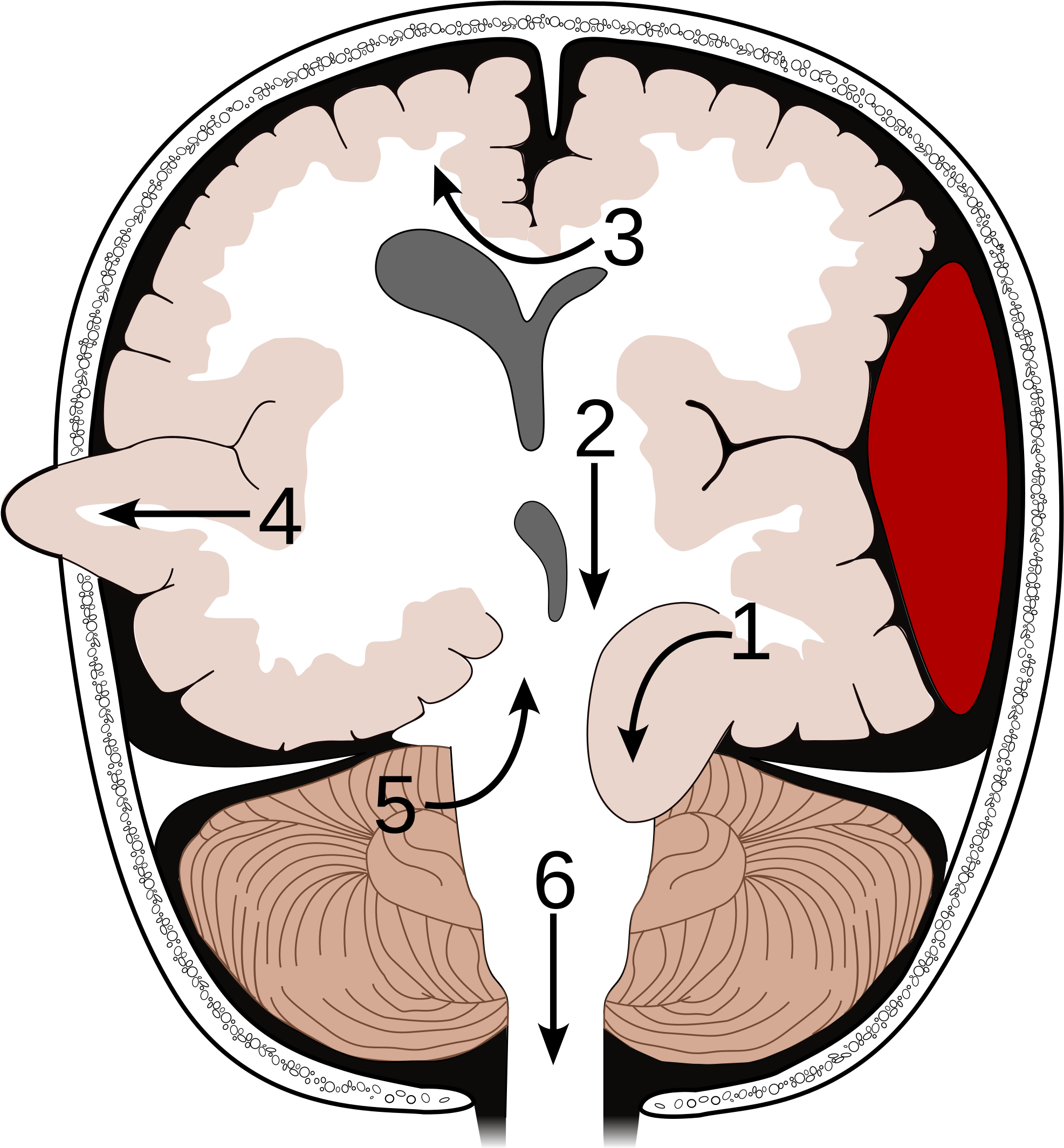 Brain - Types Of Brain Herniation (2000x2171)