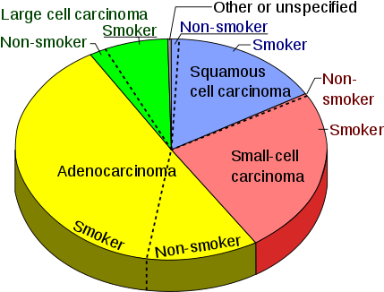Pie Chart Showing Incidence Of Adenocarcinoma Of The - Most Common Lung Cancer (440x336)