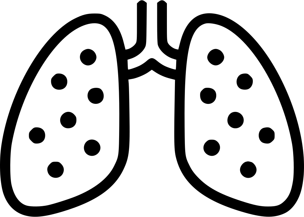 Lungs Chest X Ray Anatomy Tuberculosis Pneumonia Comments - Pneumonia (980x702)