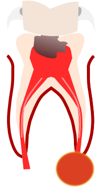 Without Endodontic Treatment The Only Other Alternative - Without Endodontic Treatment The Only Other Alternative (500x626)