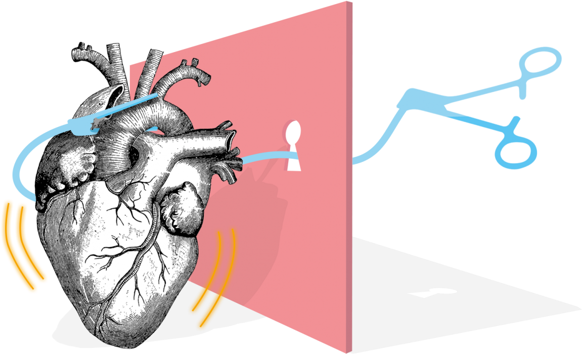 Heart Surgery - Human Heart (1500x752)