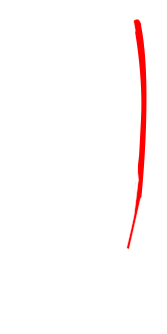 Coronary Artery Bypass - Illustration (391x339)