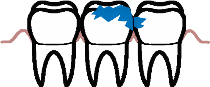 Dental Caries Is An Extremely Frequent Lesion Of The - Dental Caries Is An Extremely Frequent Lesion Of The (960x449)
