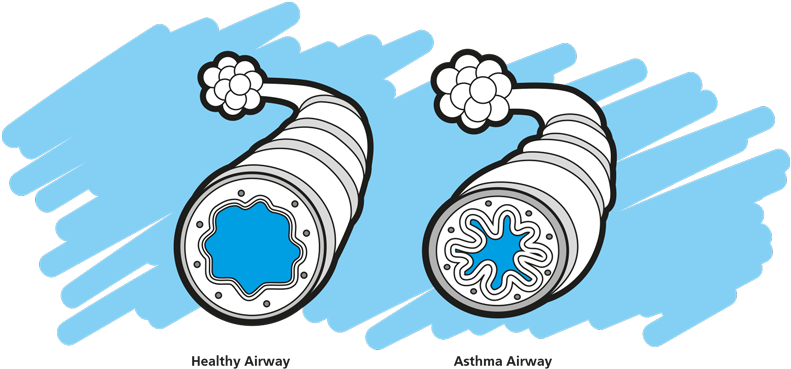 Normal & Asthma Airways - Asthma Airway Png (800x400)