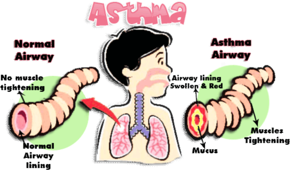 Screen 3 On Flowvella - Omega 3 And Asthma (968x644)