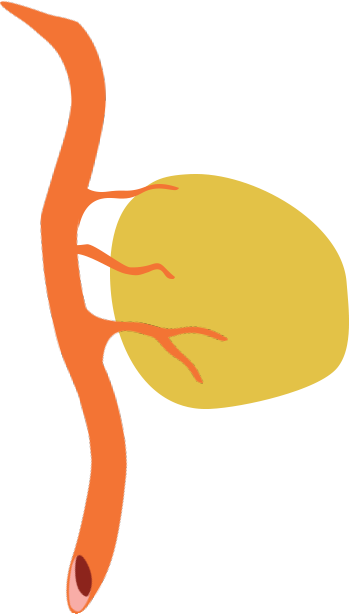 To Survive And Grow, Tumors Require Oxygen And Nutrients - To Survive And Grow, Tumors Require Oxygen And Nutrients (349x614)
