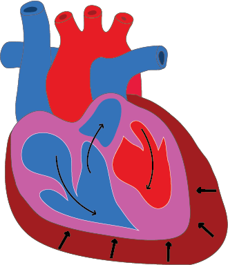 Assessment Of Pericardial Effusion - Pericardial Effusion (330x384)