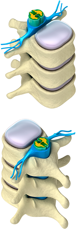 Finally A Gentle, Safe, And Effective Treatment Protocol - Intervertebral Canal (315x792)